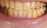 Răng ố vàng có phải là bệnh?