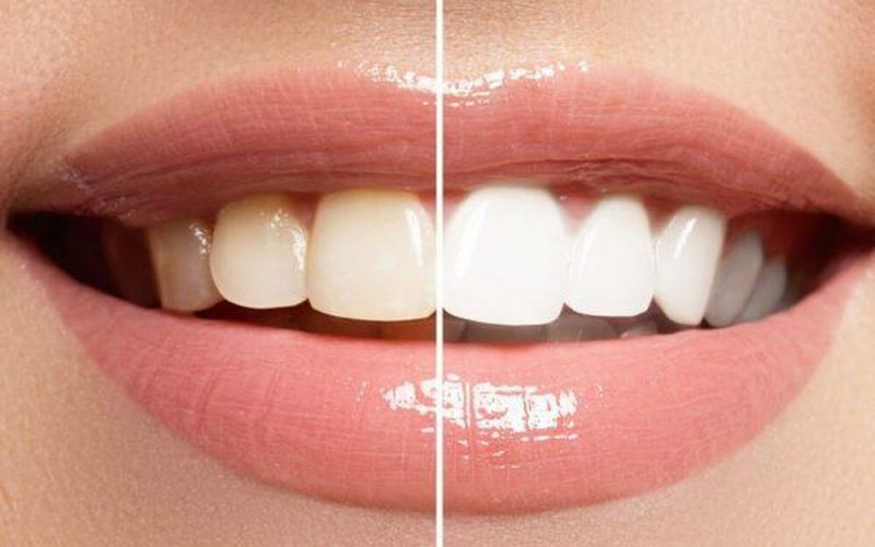 Răng sau khi tẩy trắng có bị ố vàng trở lại không?