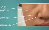 Rãnh mũi má và 'râu rồng' ở tuổi trung niên: Phương pháp thẩm mỹ nào an toàn và hiệu quả?